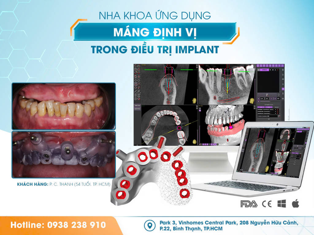 Dr. Care - Nha khoa tiên phong ứng dụng công nghệ hiện đại giúp trồng răng Implant không đau